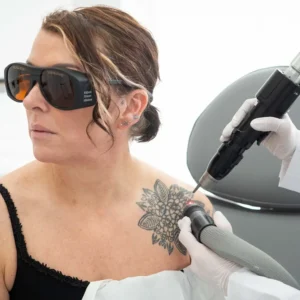 Pico Tattoo Removal